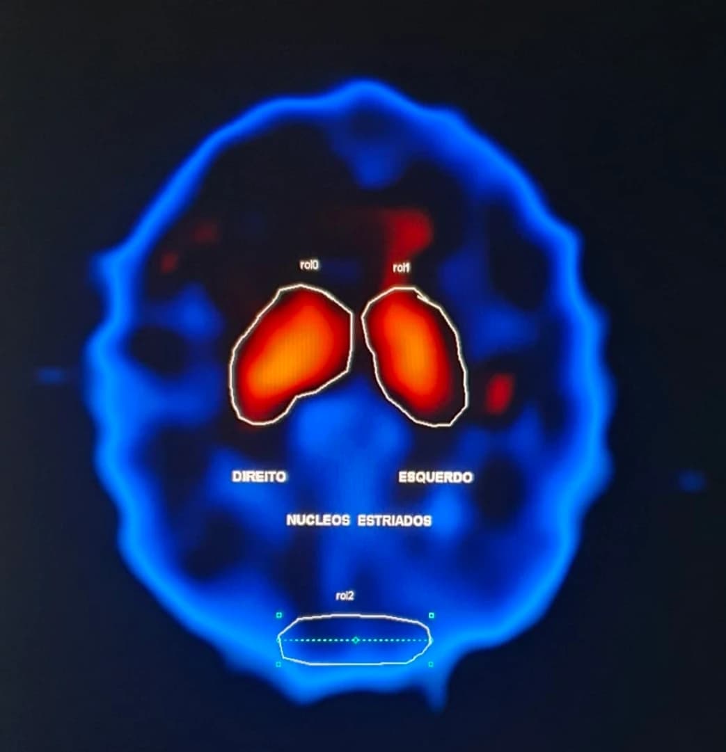 Imagem ilustrativa de SPECT cerebral com TRODAT: em vermelho e laranja, a captação nos núcleos estriados direito e esquerdo; abaixo, a região de referência usada na análise semiquantitativa.
